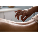 acupuntura para dor lombar marcar Maruipe