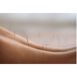acupuntura para dor nas costas marcar Santa Mônica Popular